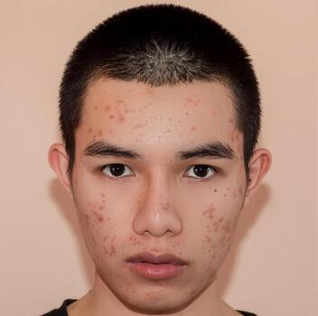 Before Psoriasis Treatment